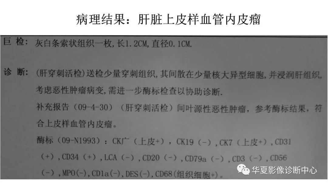 【病例】肝脏上皮样血管内皮瘤1例CT及MR影像表现