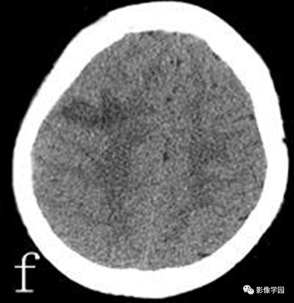 【病例】胚胎发育不良性神经上皮瘤1例MR影像诊断 【病例】胚胎发育不良性神经上皮瘤1例MR影像诊断