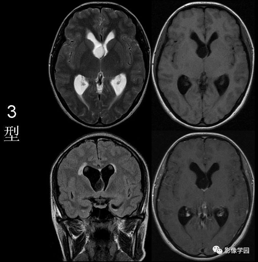 【病例】胚胎发育不良性神经上皮瘤1例MR影像诊断 【病例】胚胎发育不良性神经上皮瘤1例MR影像诊断