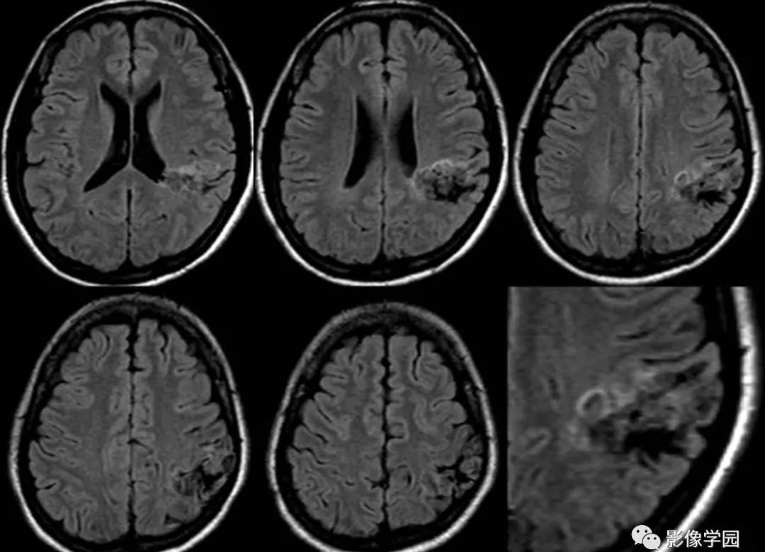 【病例】胚胎发育不良性神经上皮瘤1例MR影像诊断 【病例】胚胎发育不良性神经上皮瘤1例MR影像诊断