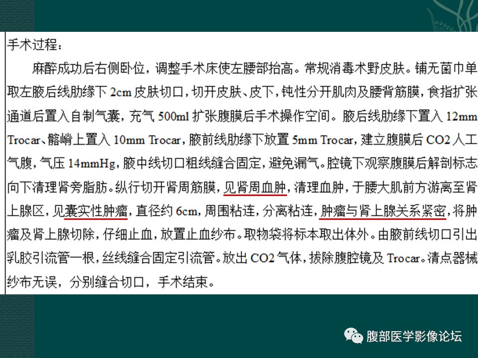 【病例】腹膜后嗜铬细胞瘤1例CT影像表现