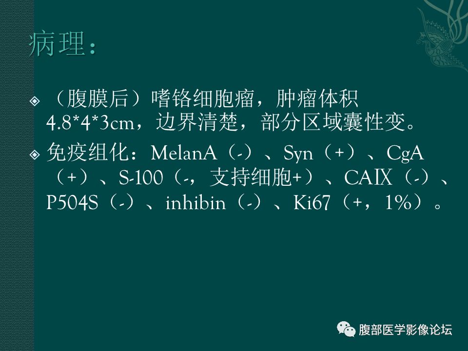 【病例】腹膜后嗜铬细胞瘤1例CT影像表现