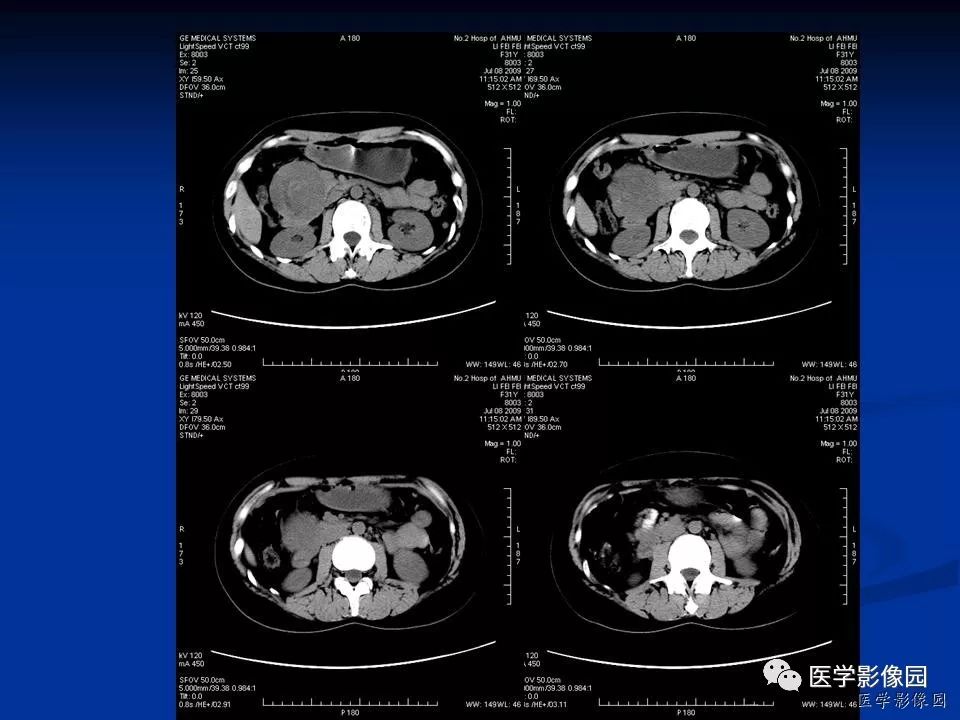 【病例】胰腺实性假乳头状瘤1例CT影像表现