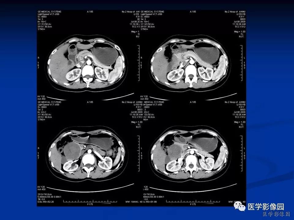 【病例】胰腺实性假乳头状瘤1例CT影像表现
