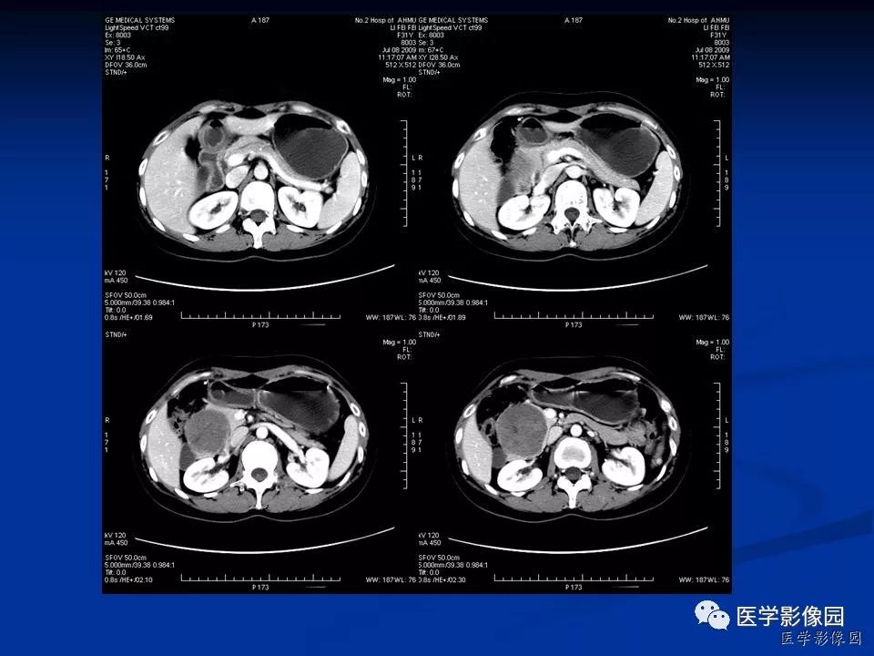 【病例】胰腺实性假乳头状瘤1例CT影像表现