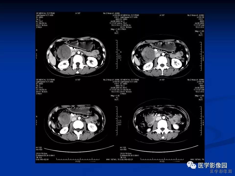 【病例】胰腺实性假乳头状瘤1例CT影像表现