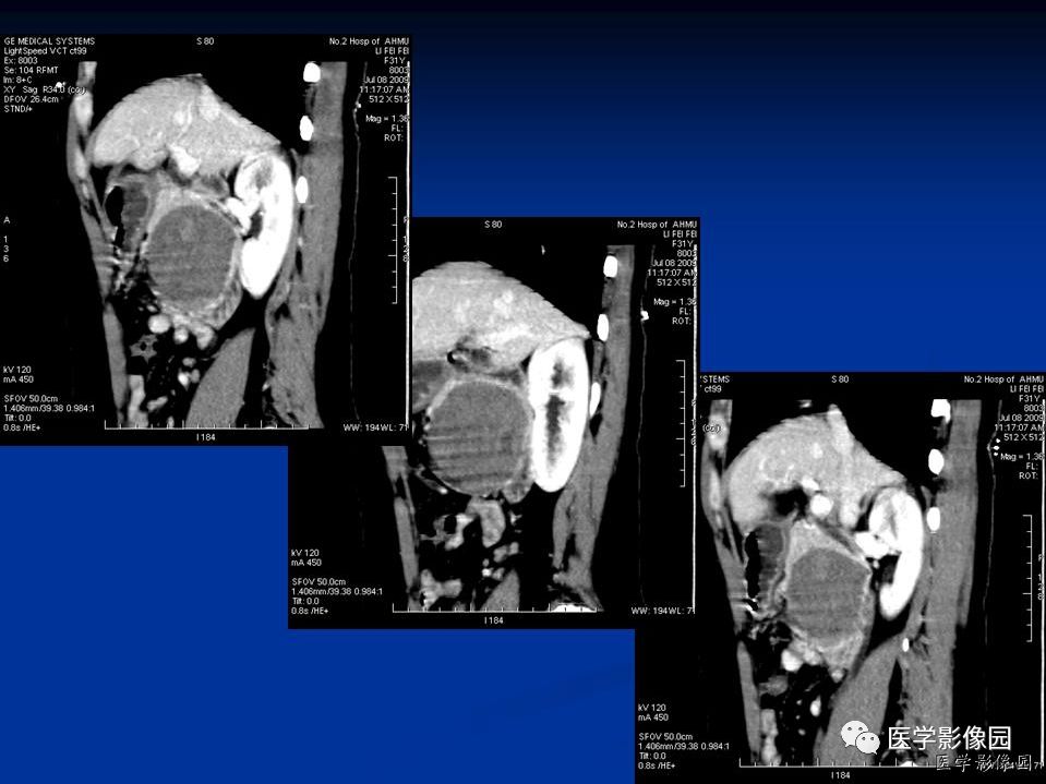【病例】胰腺实性假乳头状瘤1例CT影像表现
