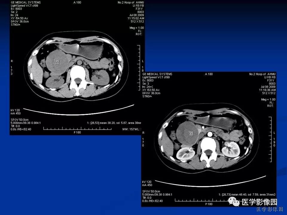 【病例】胰腺实性假乳头状瘤1例CT影像表现