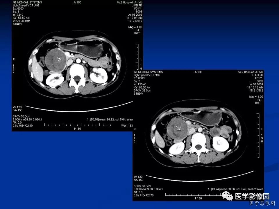 【病例】胰腺实性假乳头状瘤1例CT影像表现