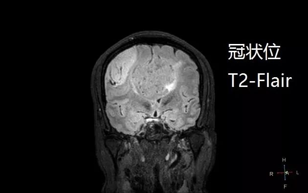 两种简单的疾病合在一起,你还敢诊断吗? 两种简单的疾病合在一起,你还敢诊断吗?