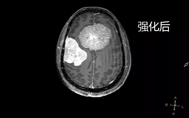 两种简单的疾病合在一起,你还敢诊断吗? 两种简单的疾病合在一起,你还敢诊断吗?