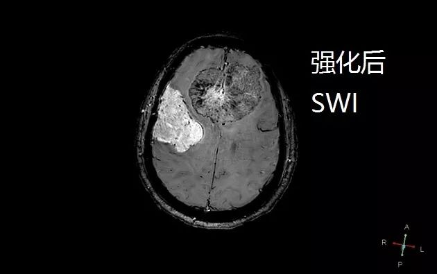 两种简单的疾病合在一起,你还敢诊断吗? 两种简单的疾病合在一起,你还敢诊断吗?