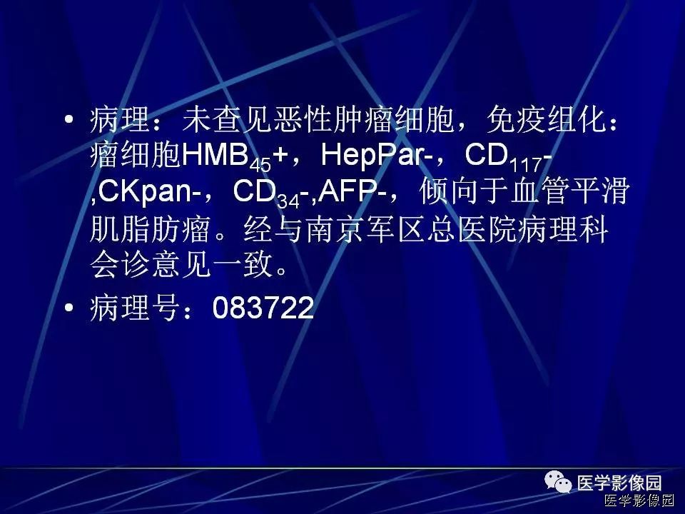 【病例】肝脏巨大血管平滑肌脂肪瘤1例CT影像表现