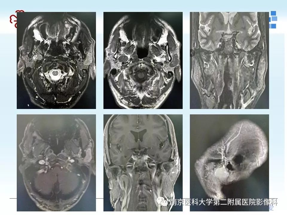 【PPT】腮腺腺淋巴瘤的影像学表现