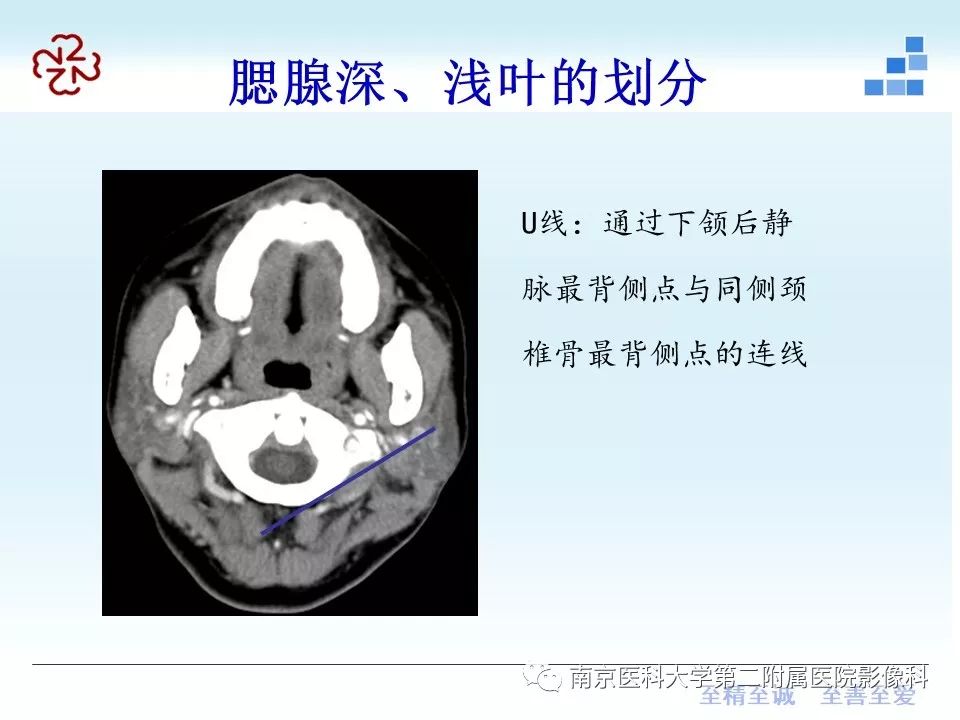 【PPT】腮腺腺淋巴瘤的影像学表现