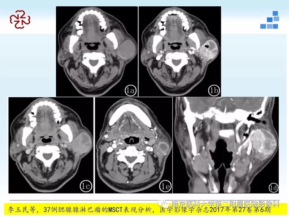 【PPT】腮腺腺淋巴瘤的影像学表现