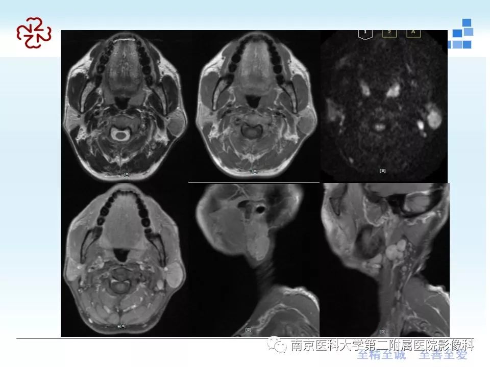 【PPT】腮腺腺淋巴瘤的影像学表现
