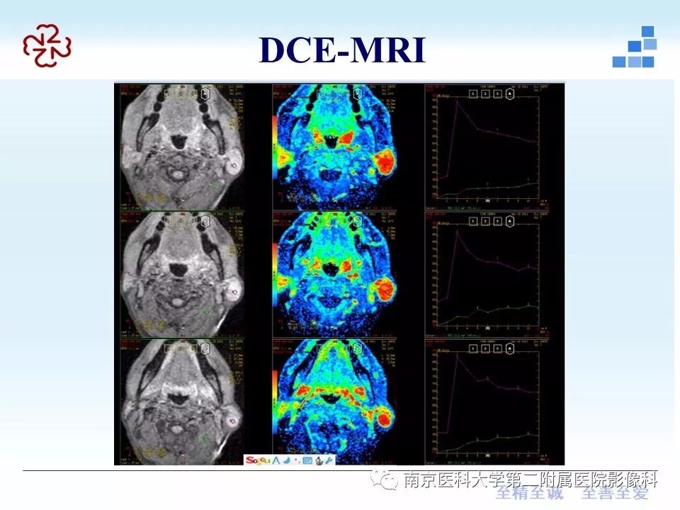 【PPT】腮腺腺淋巴瘤的影像学表现