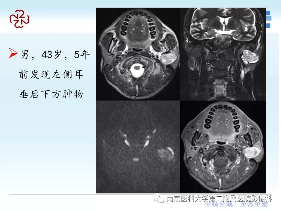 【PPT】腮腺腺淋巴瘤的影像学表现