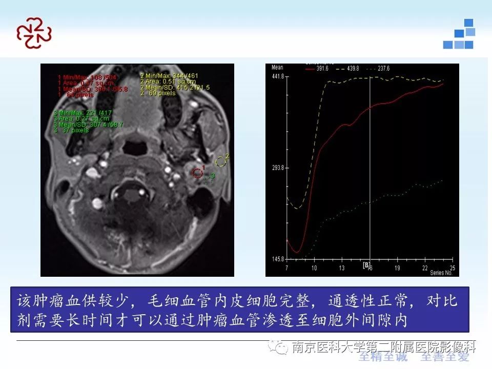 【PPT】腮腺腺淋巴瘤的影像学表现