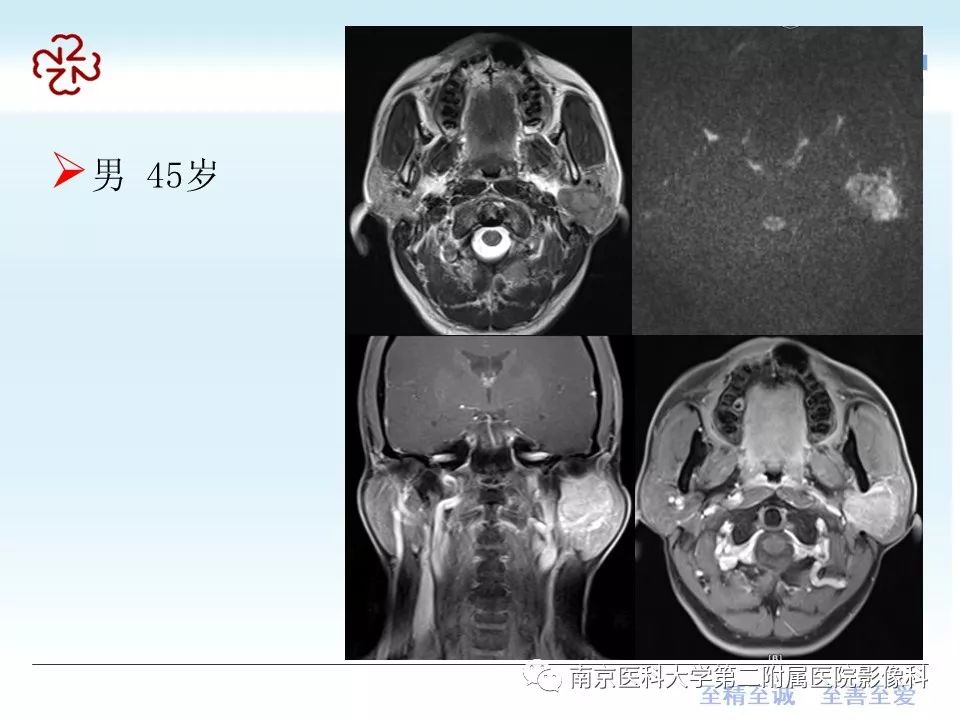 【PPT】腮腺腺淋巴瘤的影像学表现