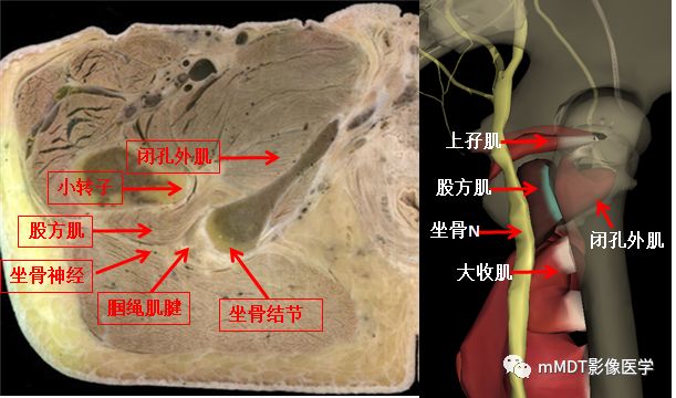 坐骨-股骨撞击综合征 坐骨-股骨撞击综合征