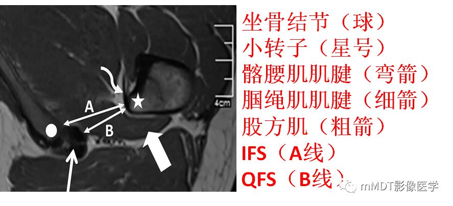 坐骨-股骨撞击综合征 坐骨-股骨撞击综合征
