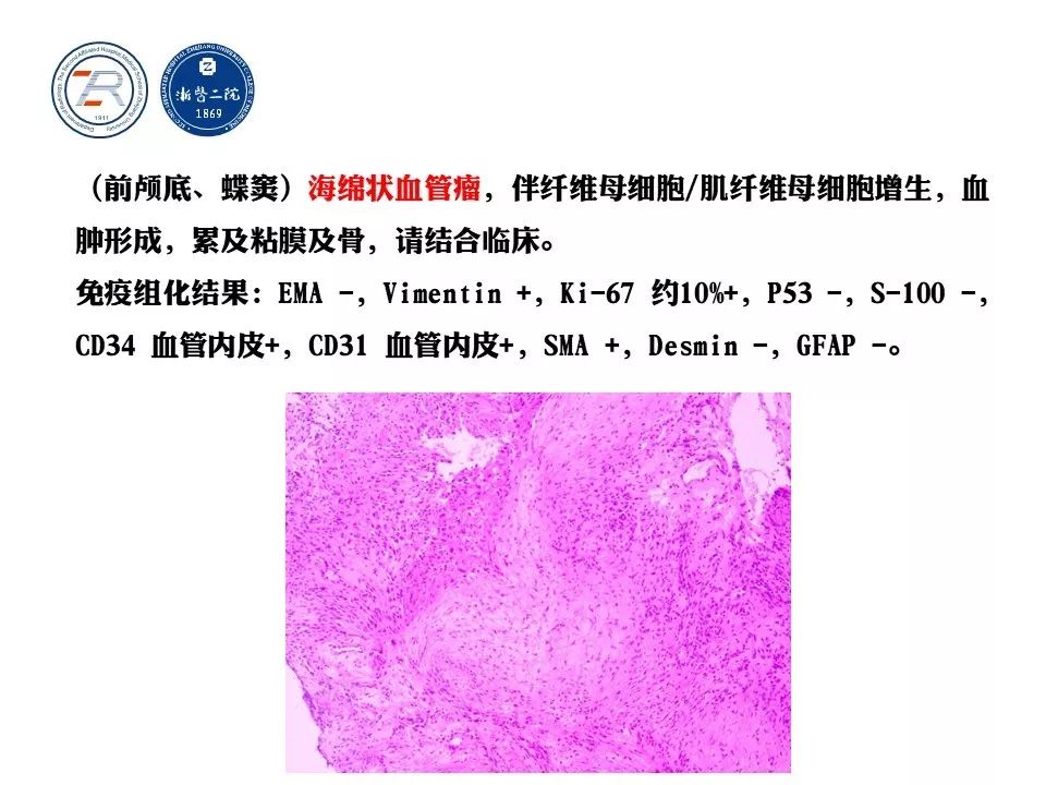 【病例】鞍区-蝶窦海绵状血管瘤1例CT及MR