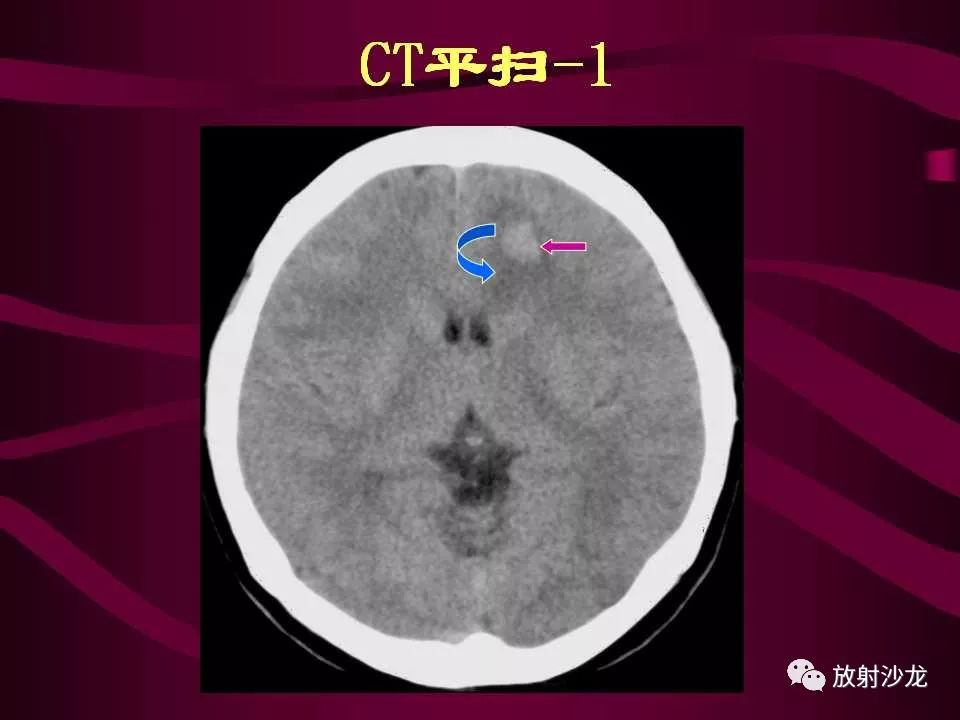 【病例】多形性胶质母细胞瘤1例CT及MR