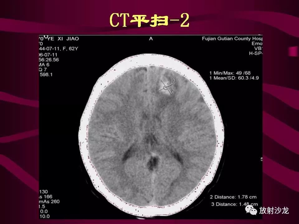 【病例】多形性胶质母细胞瘤1例CT及MR