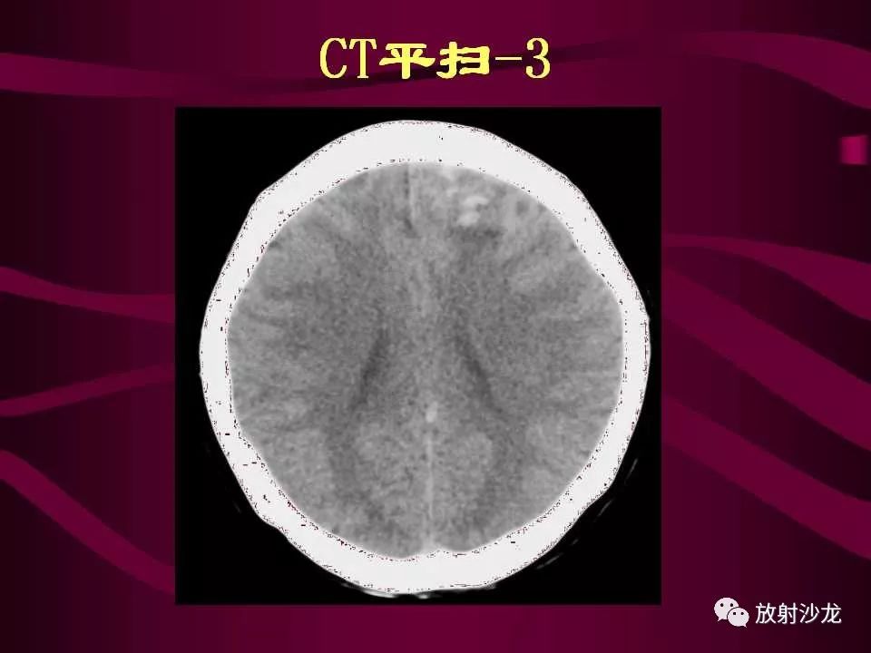 【病例】多形性胶质母细胞瘤1例CT及MR