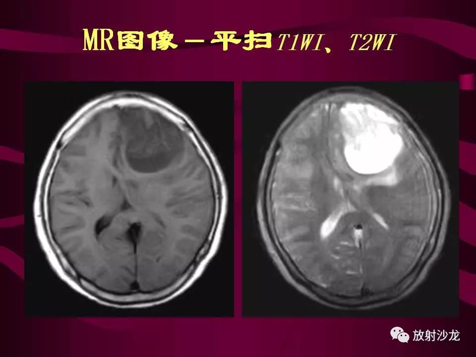 【病例】多形性胶质母细胞瘤1例CT及MR