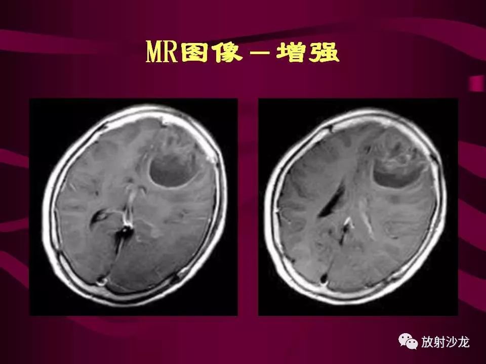 【病例】多形性胶质母细胞瘤1例CT及MR