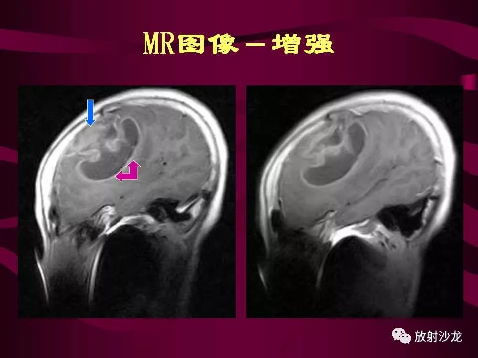 【病例】多形性胶质母细胞瘤1例CT及MR