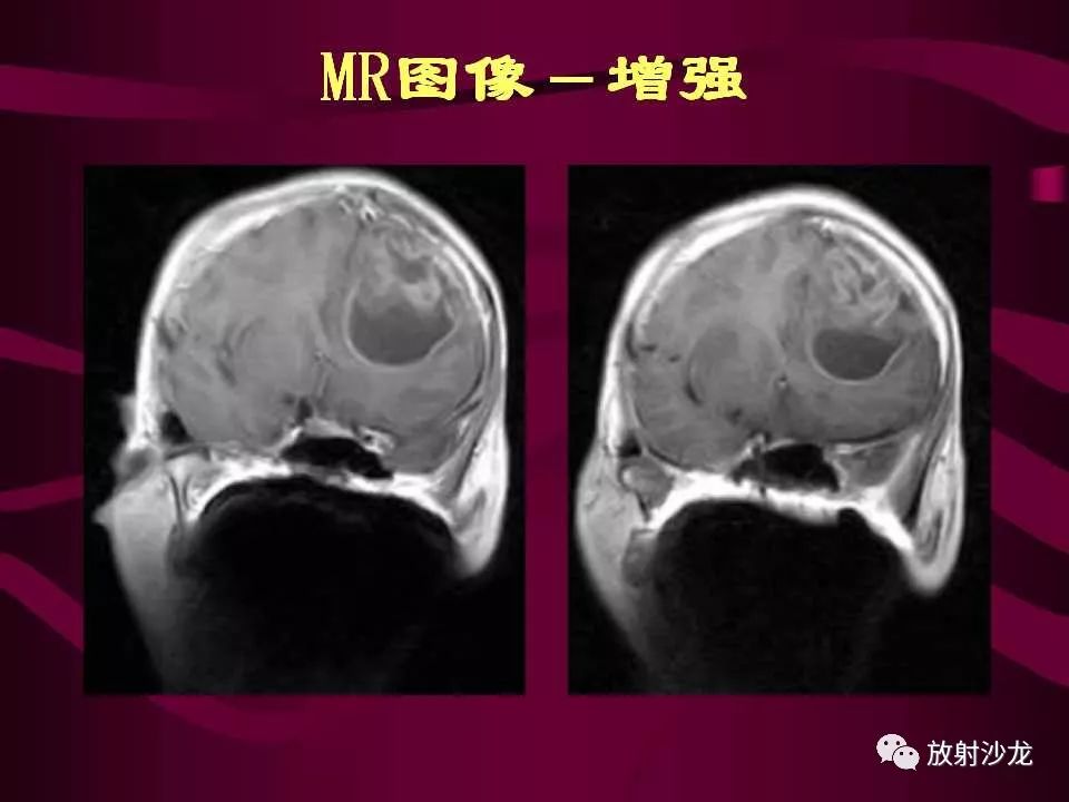 【病例】多形性胶质母细胞瘤1例CT及MR