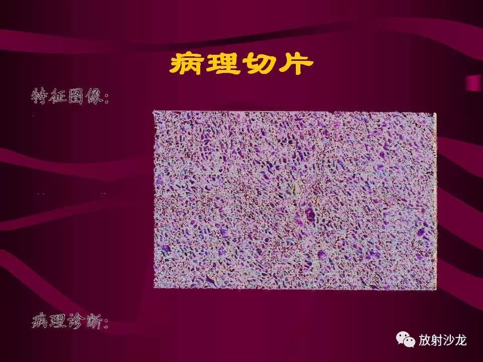 【病例】多形性胶质母细胞瘤1例CT及MR