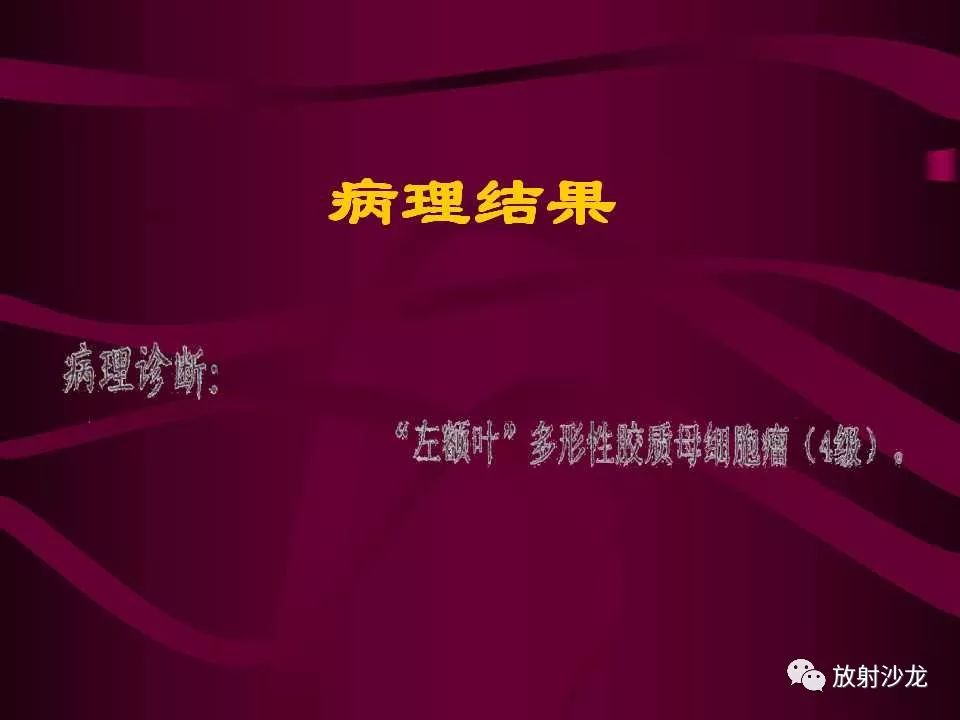 【病例】多形性胶质母细胞瘤1例CT及MR
