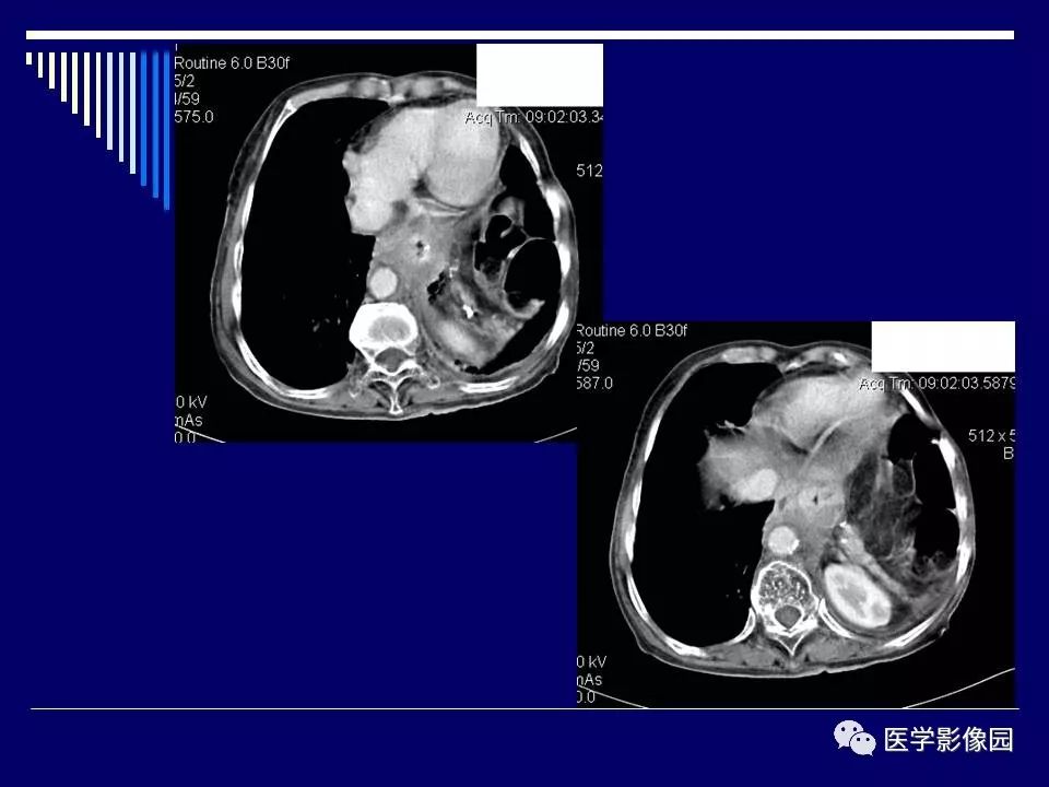 【病例】克罗恩病Crohn病1例CT