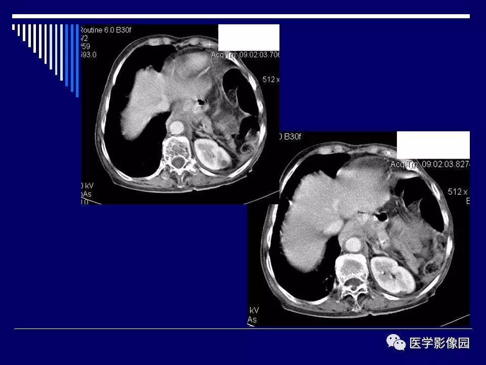 【病例】克罗恩病Crohn病1例CT