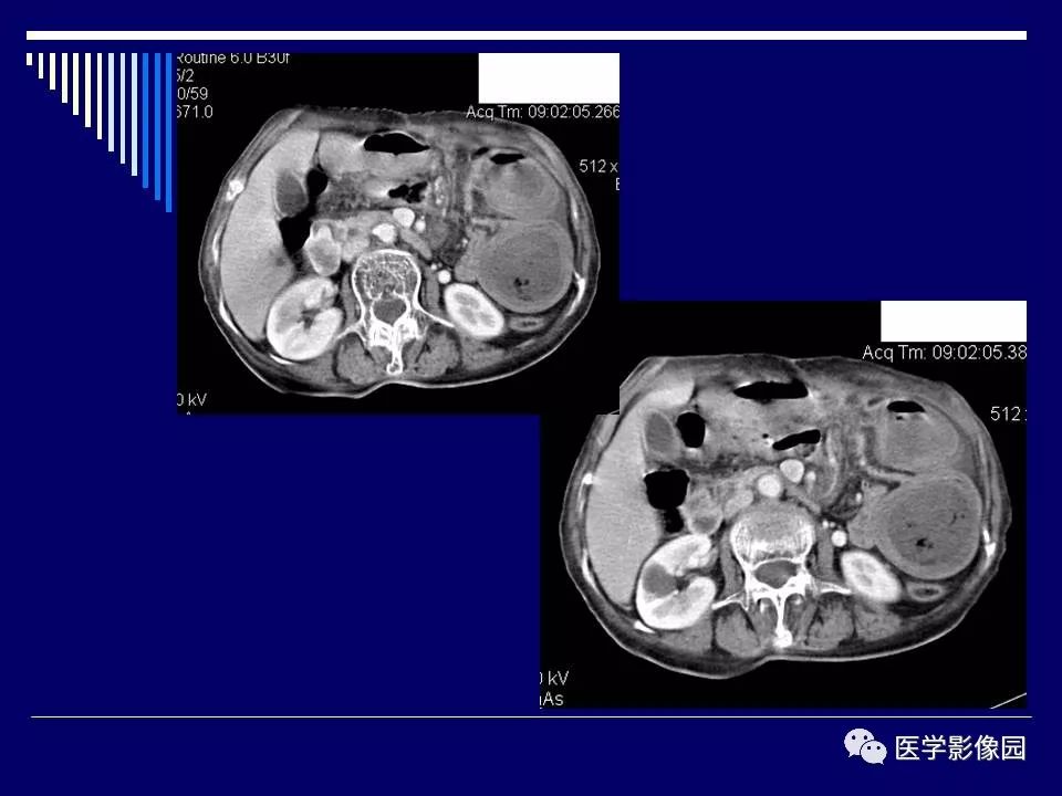 【病例】克罗恩病Crohn病1例CT