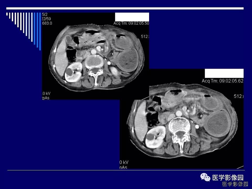 【病例】克罗恩病Crohn病1例CT