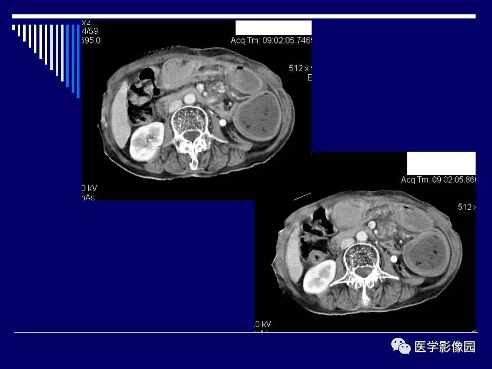 【病例】克罗恩病Crohn病1例CT
