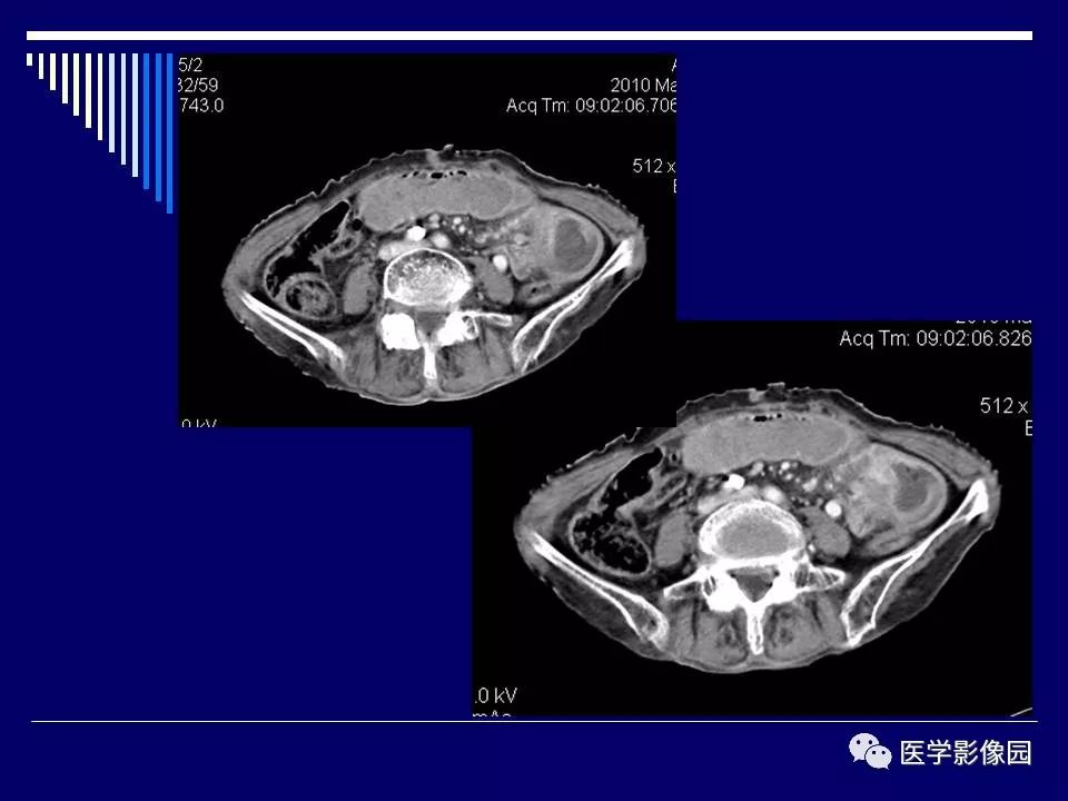 【病例】克罗恩病Crohn病1例CT