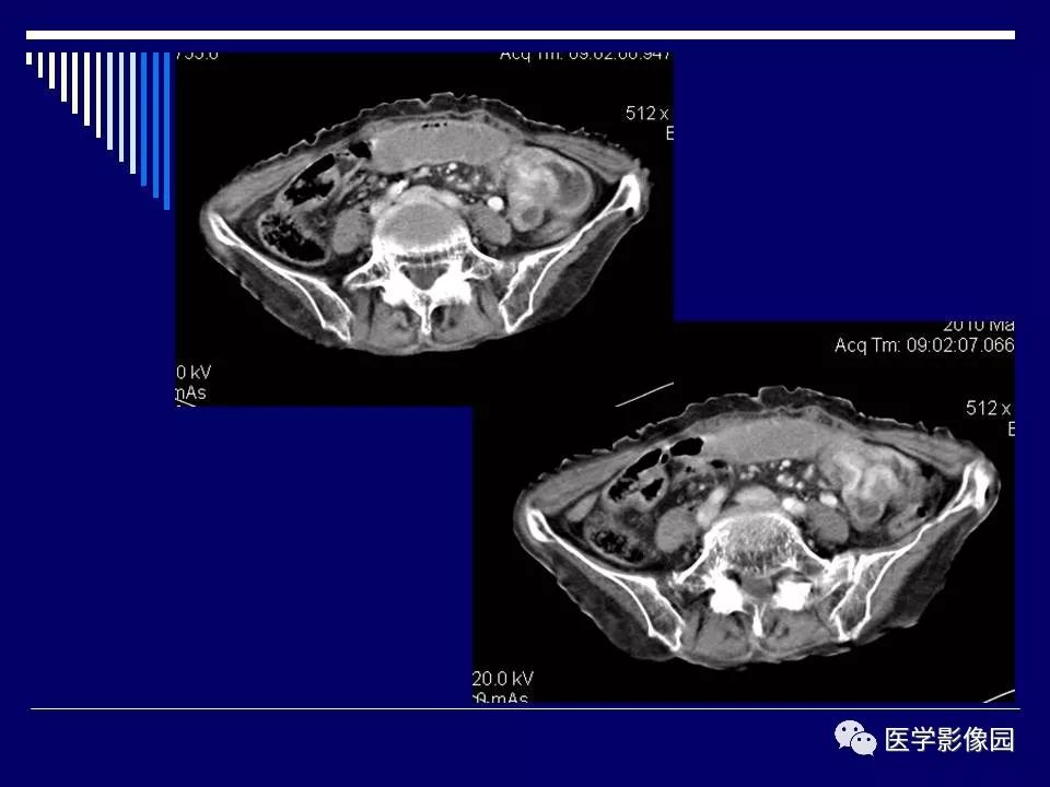【病例】克罗恩病Crohn病1例CT