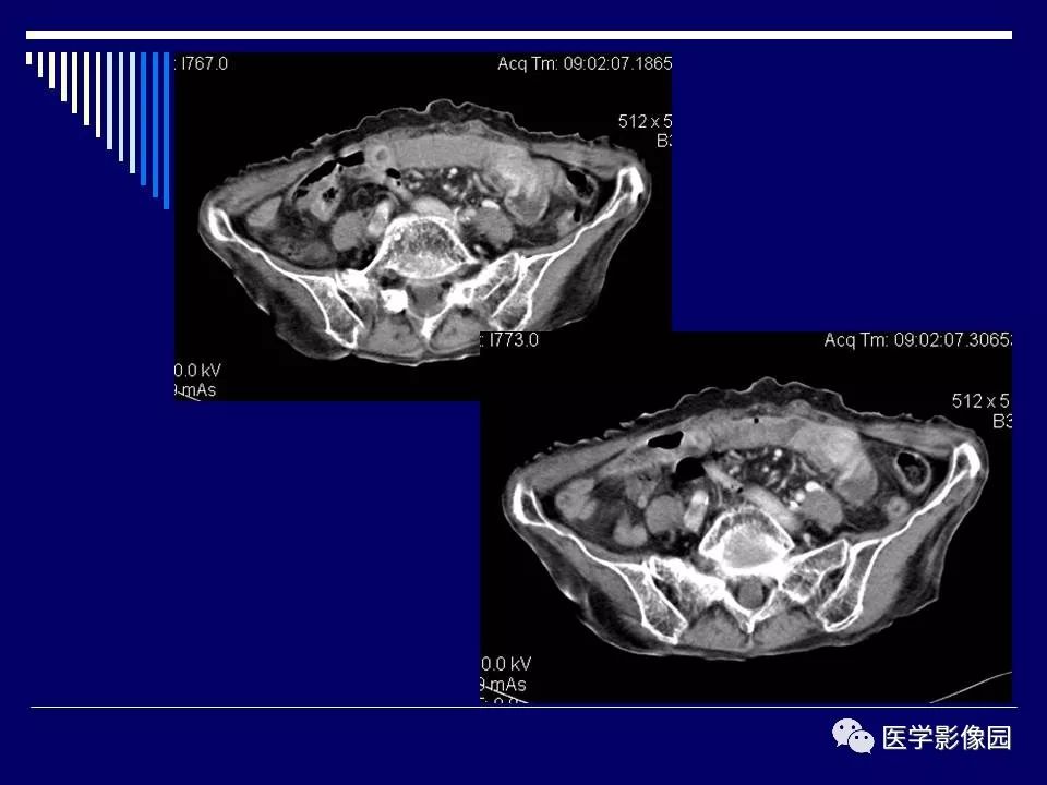 【病例】克罗恩病Crohn病1例CT