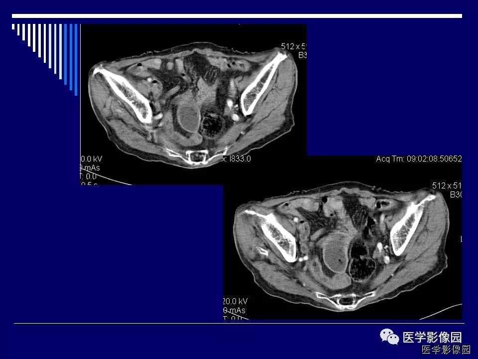 【病例】克罗恩病Crohn病1例CT