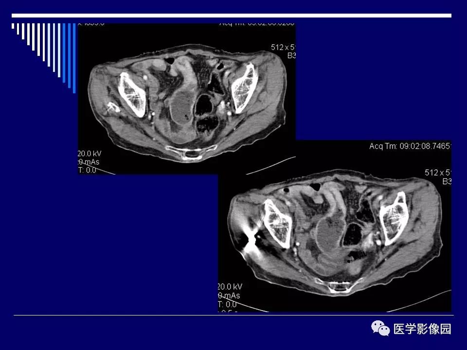【病例】克罗恩病Crohn病1例CT