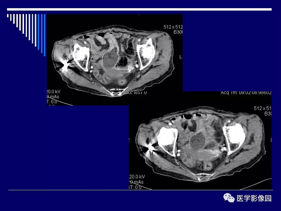 【病例】克罗恩病Crohn病1例CT