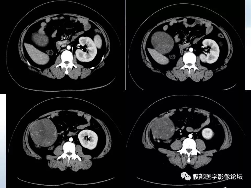 【病例】腹腔卵黄囊瘤1例CT影像表现 【病例】腹腔卵黄囊瘤1例CT影像表现