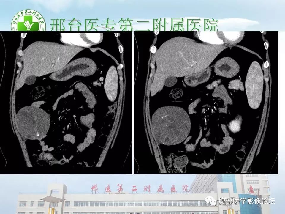 【病例】腹腔卵黄囊瘤1例CT影像表现 【病例】腹腔卵黄囊瘤1例CT影像表现